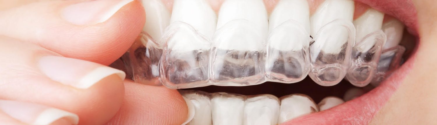Ortodoncia Brackets Invisibles Clinica Dental Dr. Reato