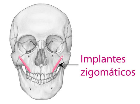 implantes-zigomaticos