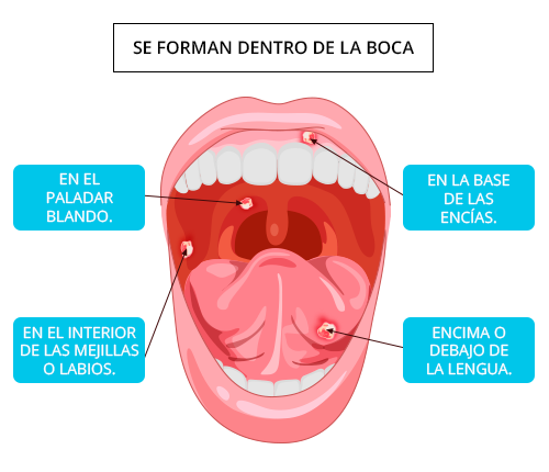 Llagas e inflamación en la boca