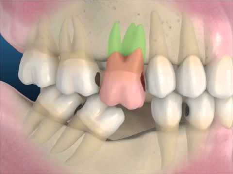 ausencia-de-piezas-dentarias