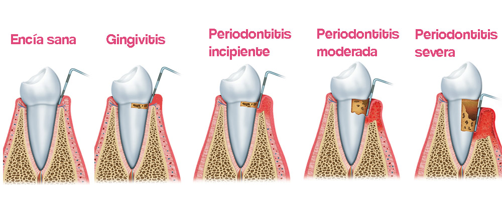 diferencia entre gingivitis y periodontitis